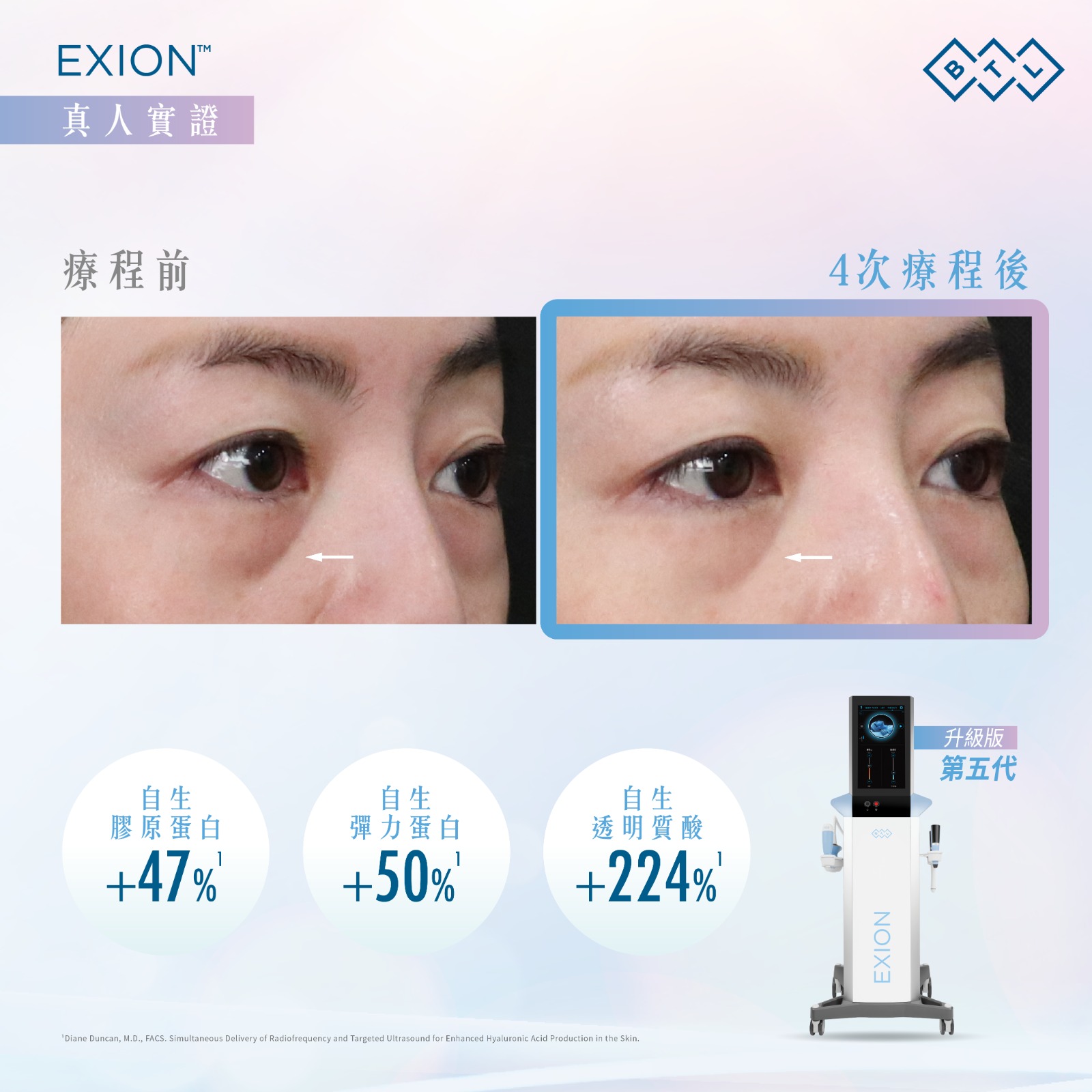 BTL EXION™ 第五代眼袋槍